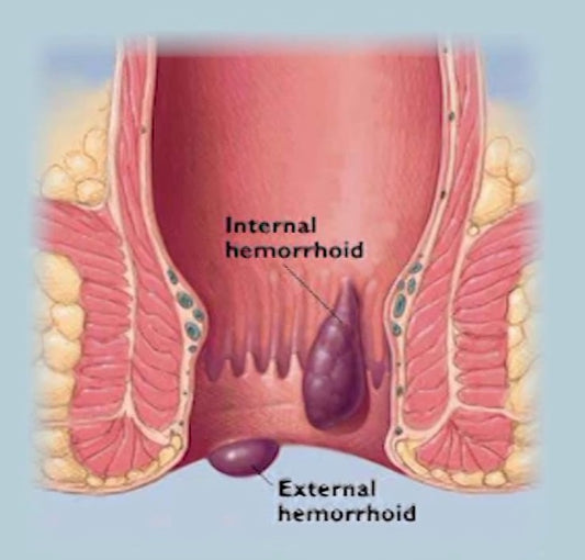 Natural cure for both bleeding and non-bleeding piles