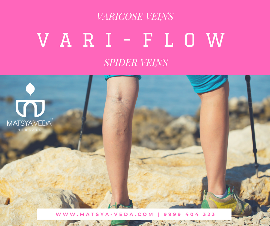 Ayurvedic Treatment of Varicosis (Varicose Veins)